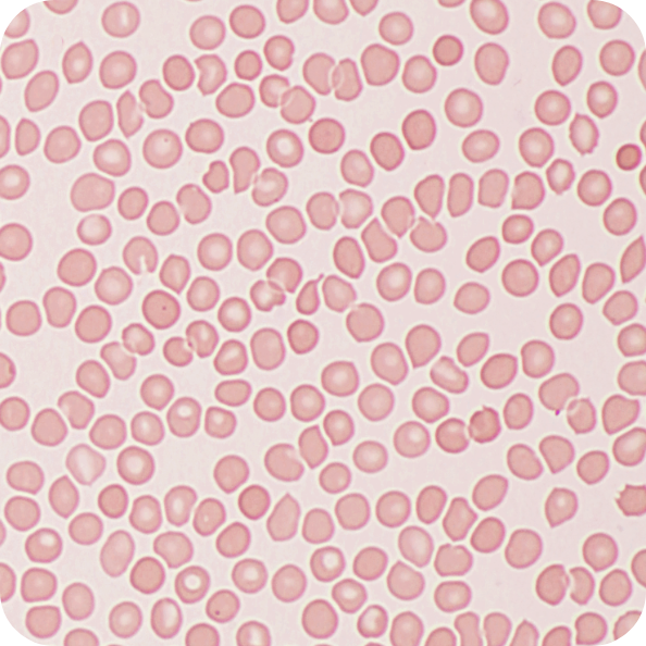 Thalassemia blood cells